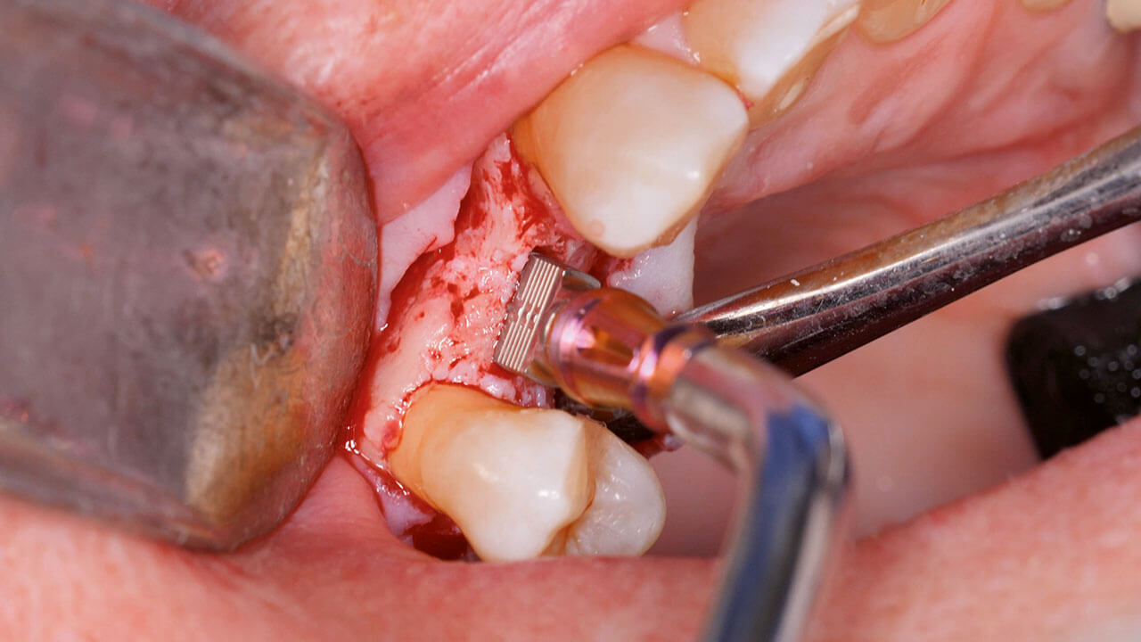 Abb. 8 Das keilförmige Implantat  wird bis zum unteren Rand der Implantatschulter passiv eingesetzt. Anschließend kommt eine spezieller elektromagnetischer Chirurgiehammer (REX Implants) zum Einsatz. Das Bild zeigt den Hammer in Aktion.