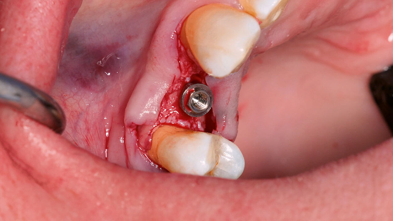 Abb. 9 Nach der Implantatinsertion liegt die Knochendicke sowohl bukkal als auch palatinal bei mehr als 1 mm.