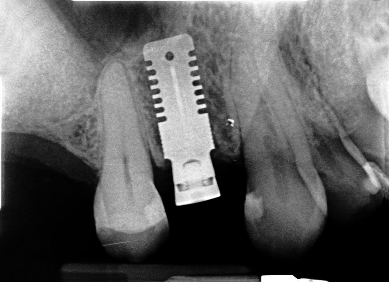 Abb. 10 Postoperative Zahnfilmaufnahme.