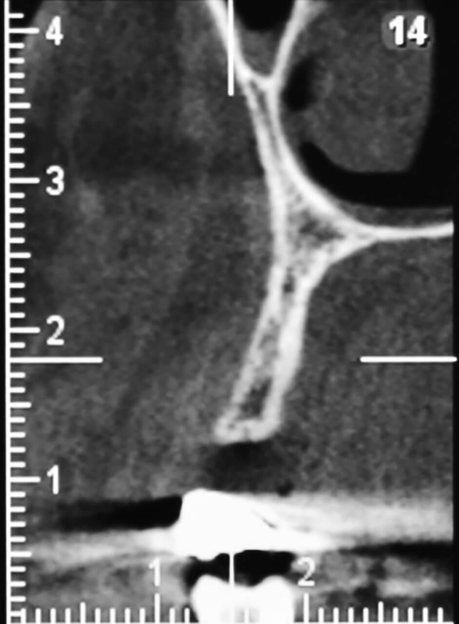 Abb. 14 Die röntgenologische Analyse der Kammbreite offenbart einen schweren horizontalen Knochendefekt.