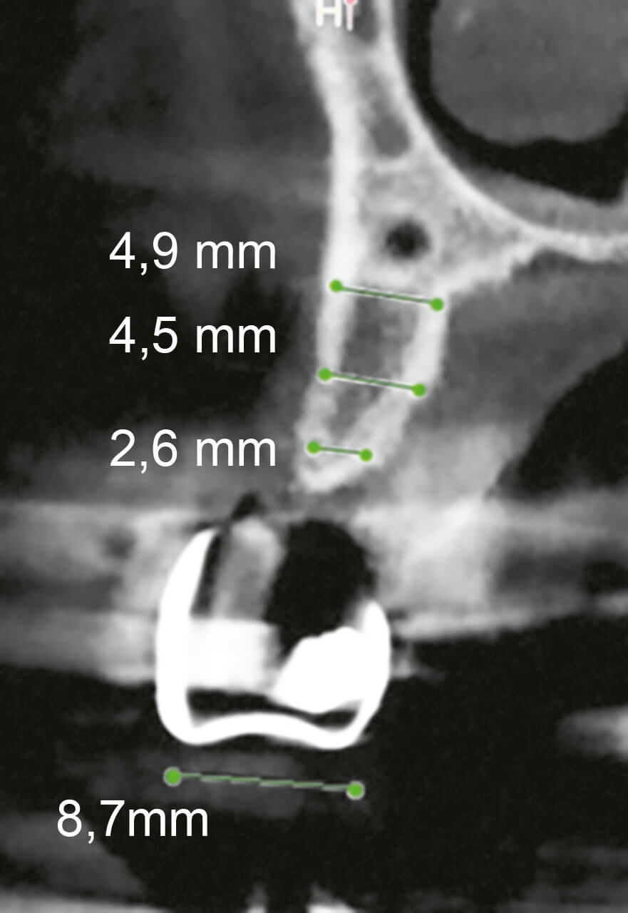 Abb. 20 Die Röntgenanalyse der Kammbreite zeigt einen schweren horizontalen Knochendefekt.