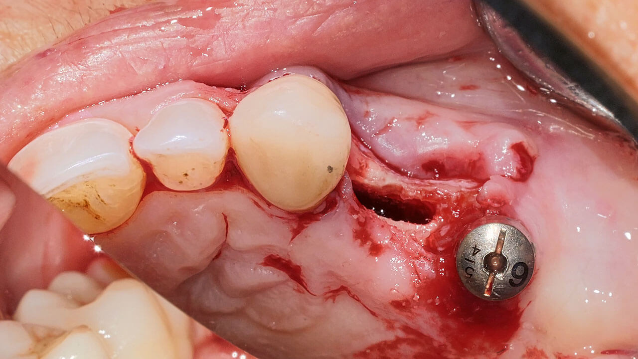 Abb. 25 Das Bild zeigt die Expansion der Implantatstelle und die halbkreisförmige Pilotosteotomie, die für die korrekte mesiodistale Positionierung des Implantats erforderlich ist.