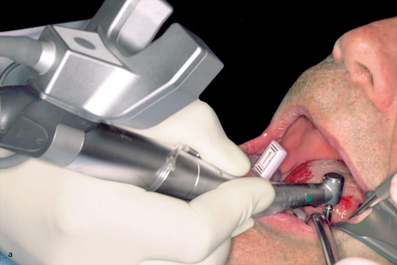 Abb. 2 a Implantatinsertion: Zwischen dem optischen Kamerasystem und dem intraoralen Referenzmarker muss die Sicht gewährleistet sein.
