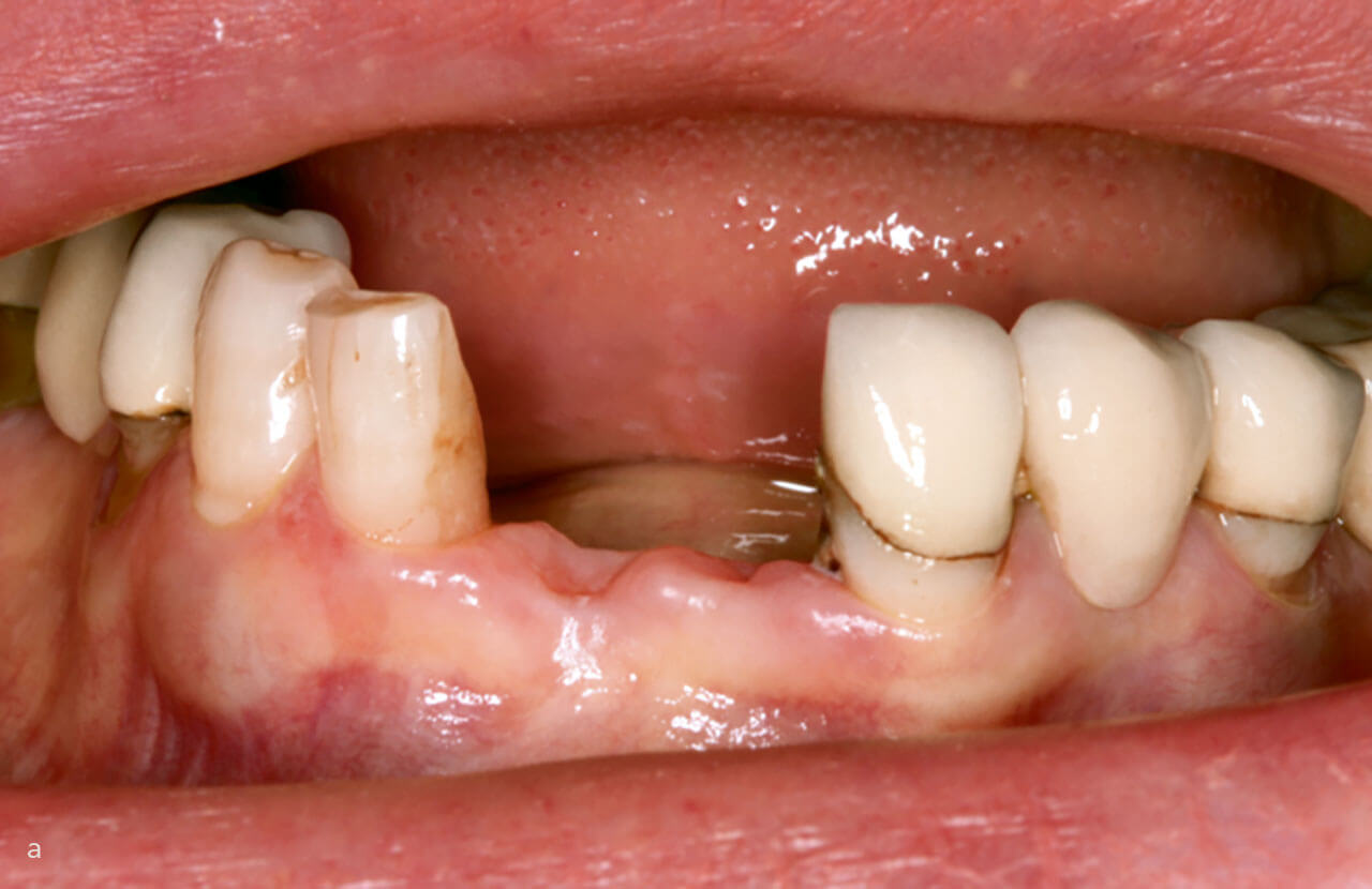 Abb. 3 a Ausgangssituation: Frontzahnlücke mit fehlenden Zähnen 31 und 41.
