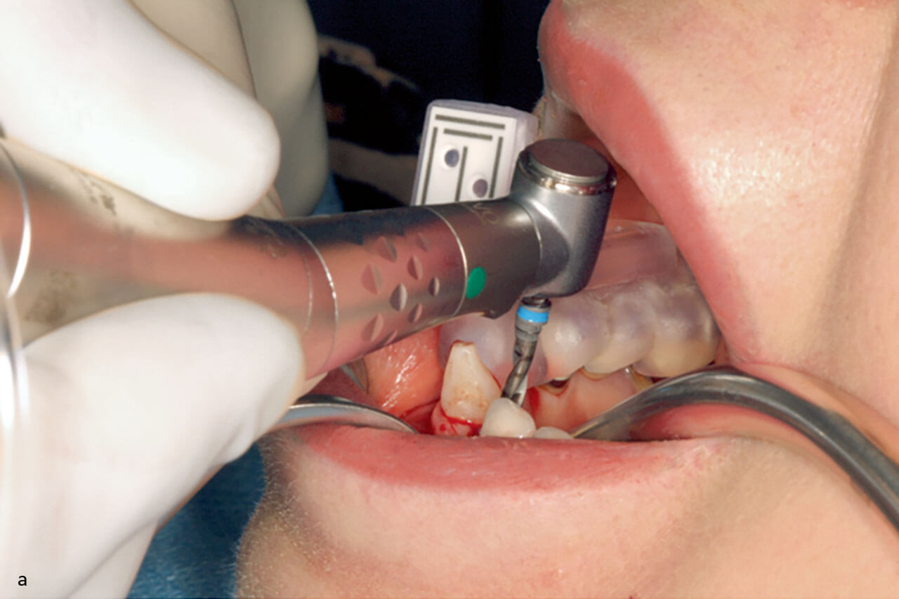 Abb. 4 a Die Implantatbettaufbereitung erfolgte laut Herstellerprotokoll.
