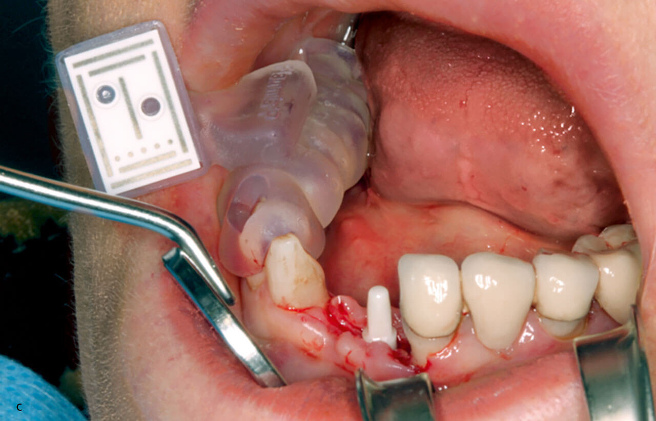 Abb. 4 c Das keramische Implantat Regio 31 in situ: Nachträglich wurden keine Änderungen der Implantatposition vorgenommen.