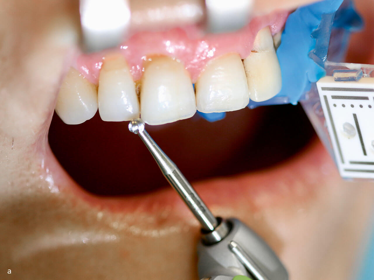 Abb 4 a Regelmäßige Kontrolle der Systemgenauigkeit während eines Eingriffs (Bohrerspitze an Zahn): Anatomische Landmarks werden mit der Bohrerspitze markiert.