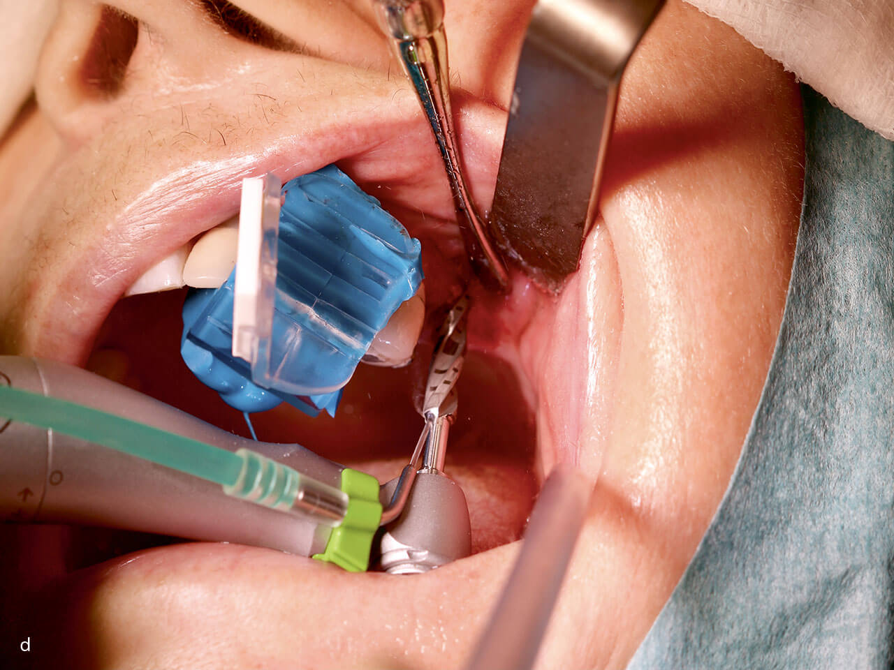 Abb. 6 d Situation im Patientenmund bei der navigierten Aufbereitung des Implantatbetts.