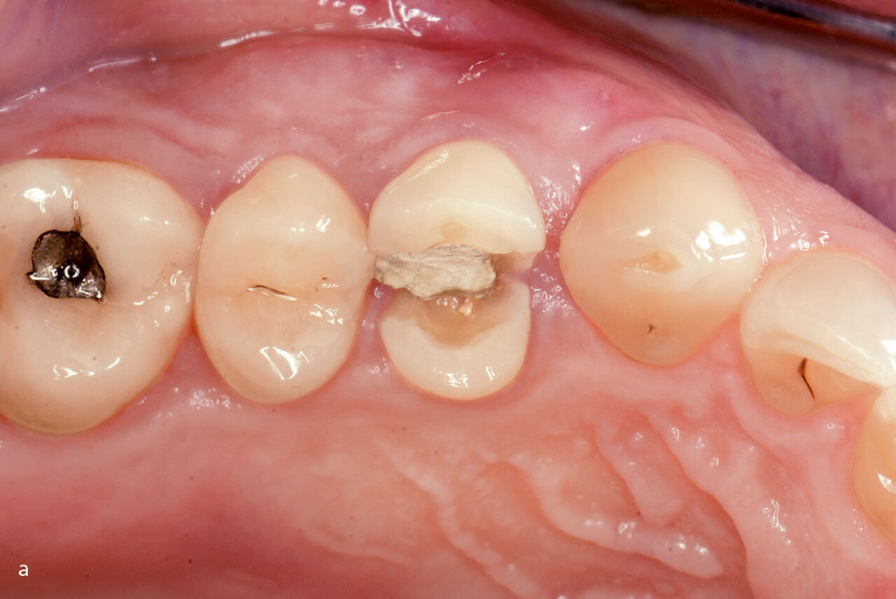Abb. 1a Repräsentativer Fall eines Zahns 14: intraorales Bild bei der Erstvorstellung (Baseline).