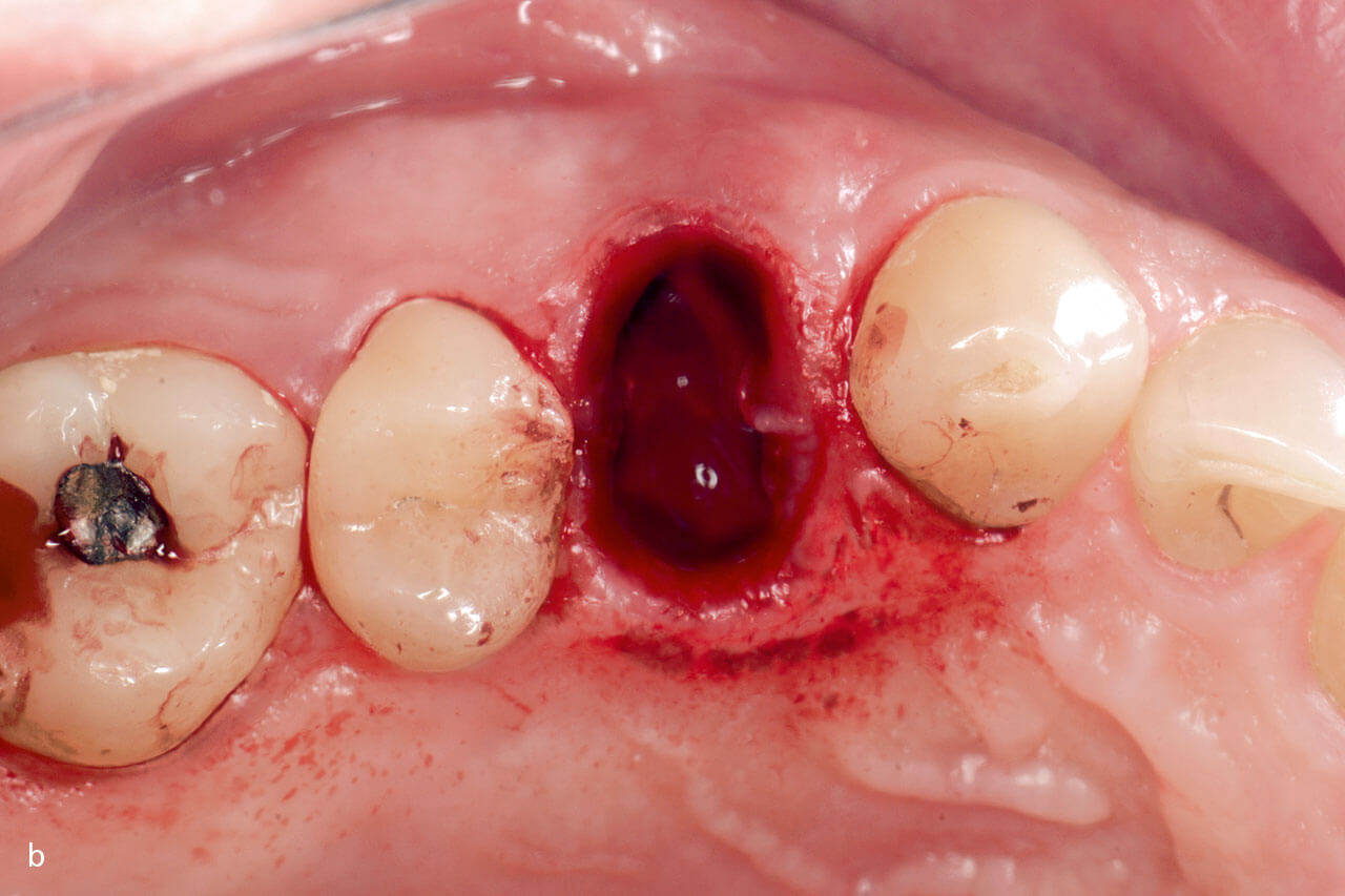 Abb. 1b Repräsentativer Fall eines Zahns 14: die Alveole unmittelbar nach der minimalinvasiven, lappenfreien Extraktion. Alle vier Knochenwände wurden erhalten.