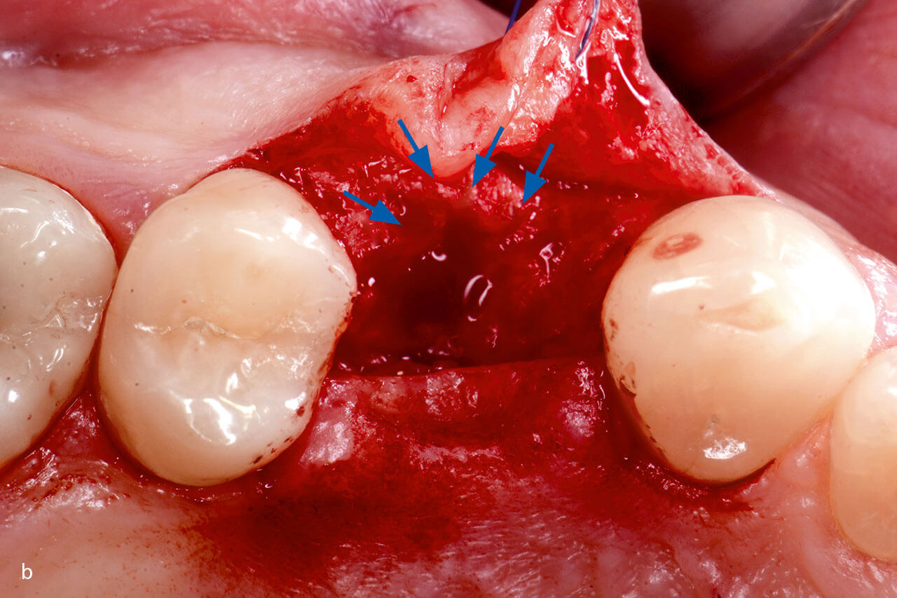 Abb. 2b Elevation eines minimalen Lappens und Präparation der Stelle für die Implantatinsertion. Das frühe Heilungsgewebe (blaue Pfeile) wurde bei der Lappenelevation nicht bewegt. 