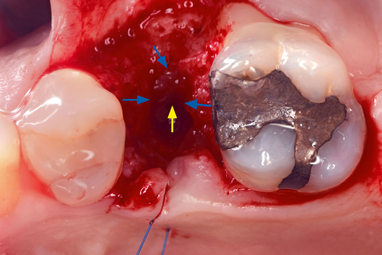 Abb. 3 Das frühe Heilungsgewebe (gelber Pfeil) wurde auf die bukkale Seite transferiert, wo es am ortsständigen bukkalen (blaue Pfeile) Knochen haftet. 