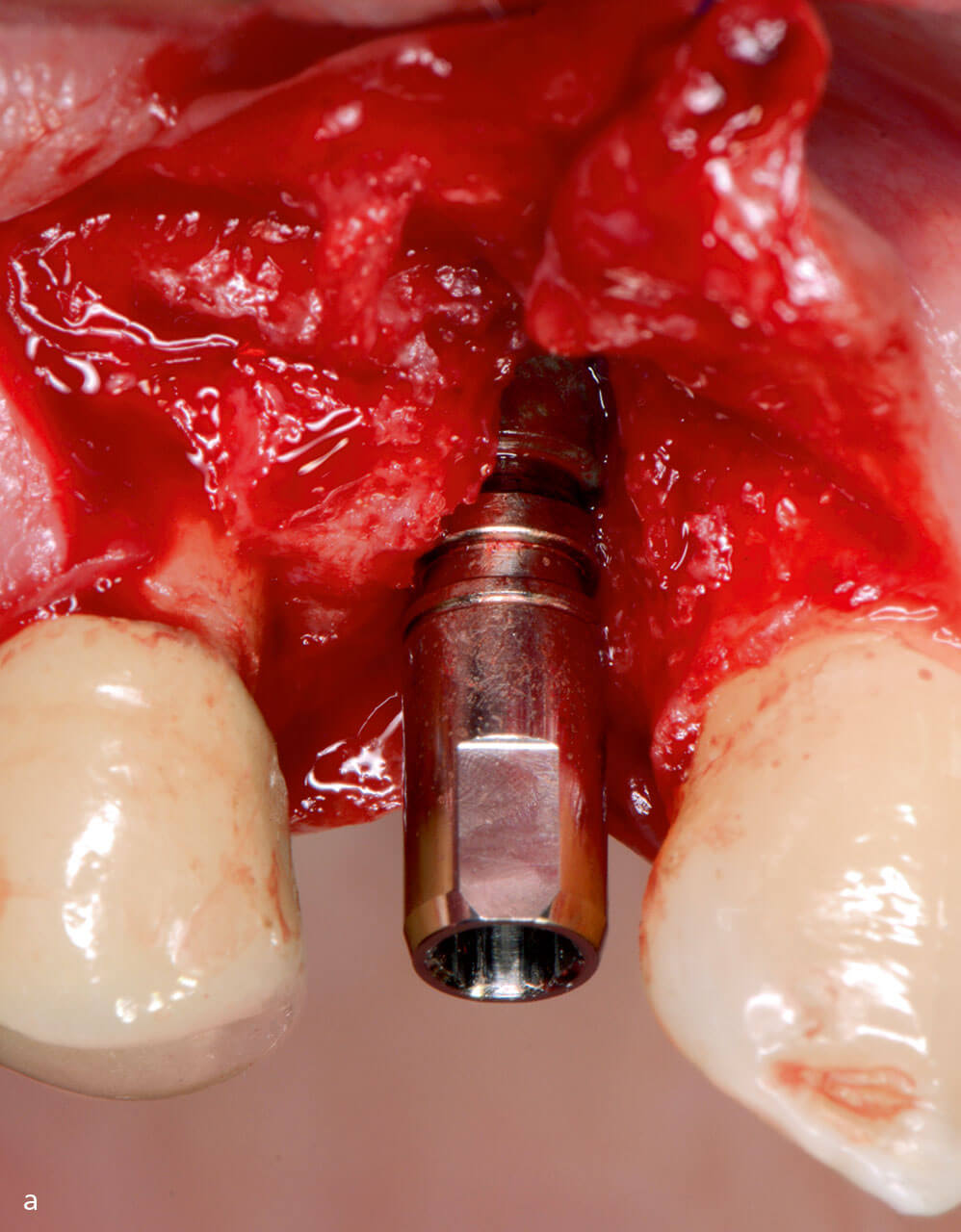 Abb. 4a und b Fall mit fehlender bukkaler Knochenwand: a) Situation am Tag der Implantatsetzung und b) bei der Freilegungsoperation.