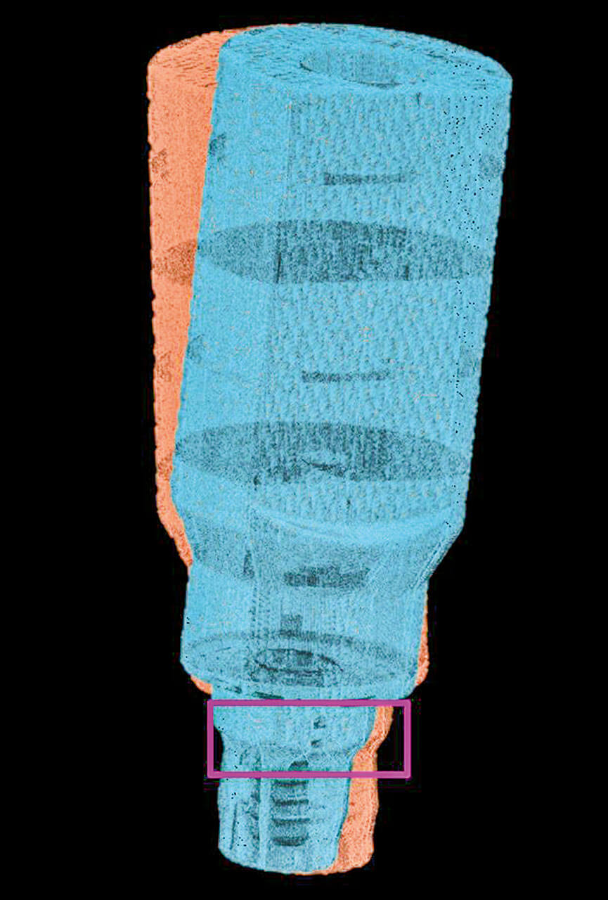 Abb. 15 Schematische Darstellung des Volumens der realen Implantatposition (pinkfarbenes Rechteck) und maximal mögliche Neigung aufgrund von herstellerbedingter Imperfektion bzw. hohen Fertigungstoleranzen des Scanbodys (blauer und orangefarbener Scanbody).