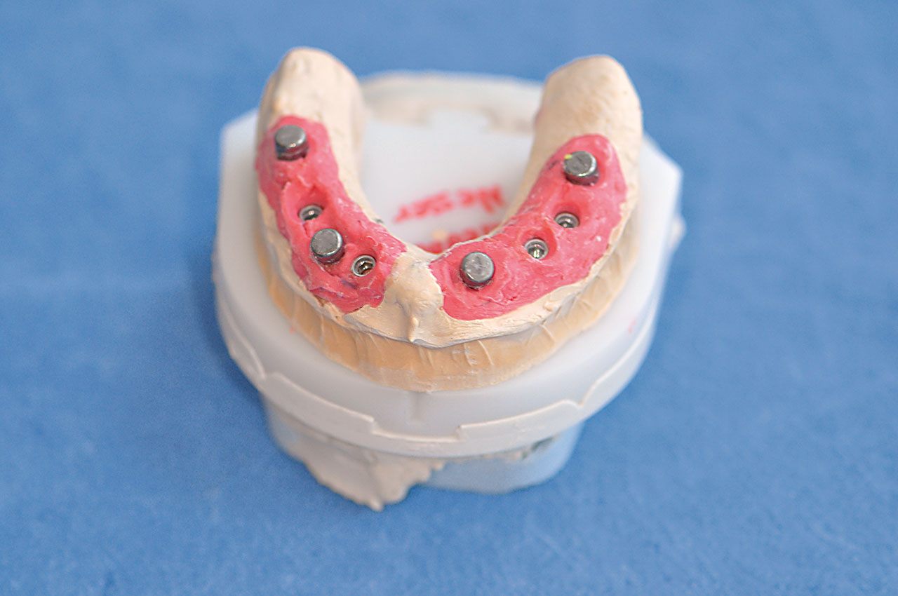 Abb. 7 Gipsmodell mit identischen, im Mund eingebrachten Gingivaformern bei Zahnlosigkeit.