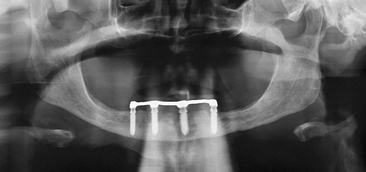 Abb. 1 Bildgebende Diagnostik bei der Erstvorstellung (Panoramaschichtaufnahme): Periimplantärer Knochenabbau an den Implantaten 34, 32 und 42.