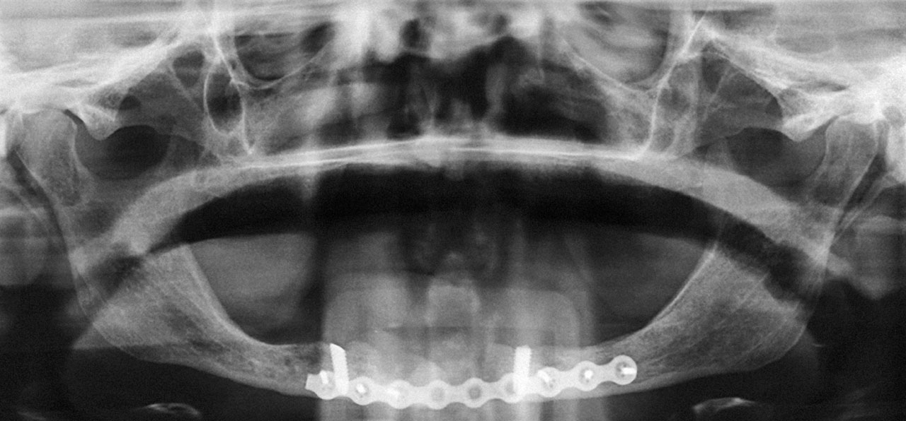 Abb. 4 Die postoperative Panoramaschichtaufnahme zeigt die Frakturversorgung mittels Titanplattenosteosynthese im Unterkiefer. Das Implantat 42 wurde entfernt. Die Implantate 34 und 44 wurden auf das Knochenniveau reduziert, um eine weitere Schwächung des Knochens zu vermeiden.