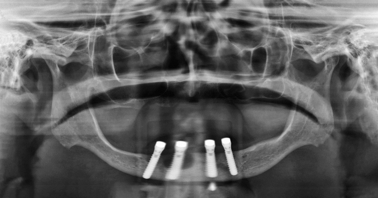 Abb. 5 Die Panoramaschichtaufnahme zeigt bei allen vier Implantaten einen Knocheneinbruch, am ausgeprägtesten in Regio 42.