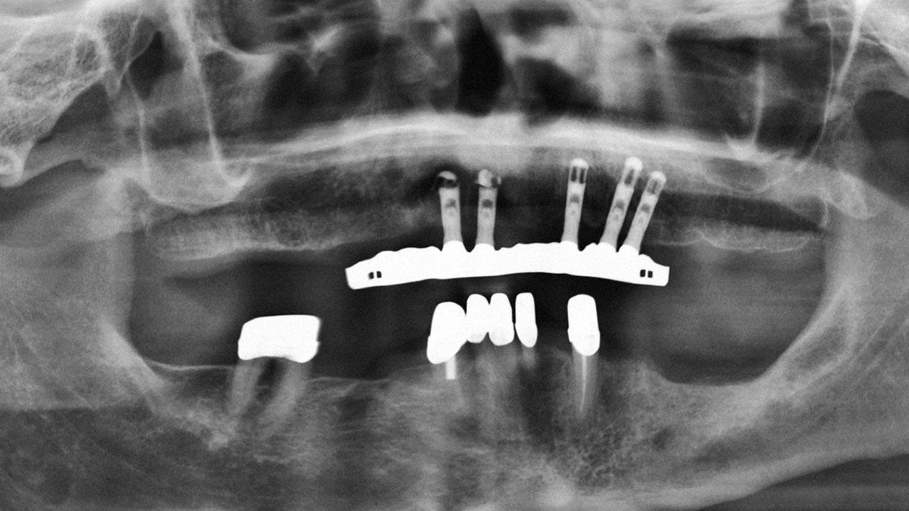 Abb. 11 Die Panoramaschichtaufnahme zeigt die frakturierten Implantate im I. Quadranten, welche die Abstützung für die Stegversorgung rechts darstellen.