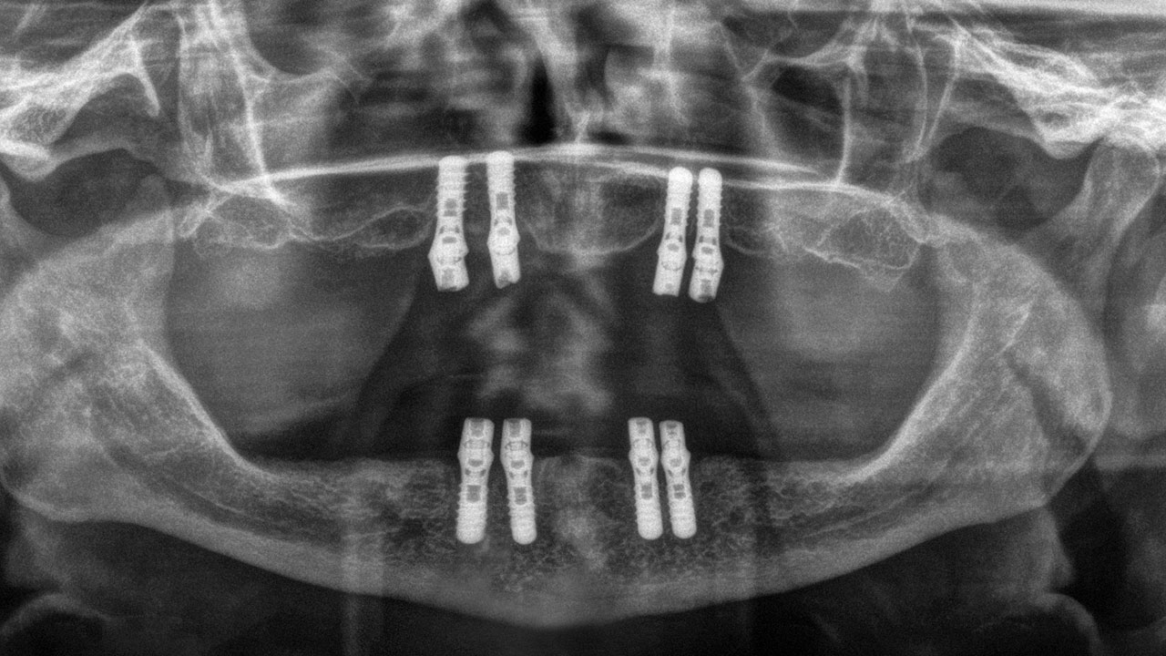 Abb. 18 Panoramaschichtaufnahme 2018: Marginale Knocheneinbrüche sind an allen vier Implantaten feststellbar.