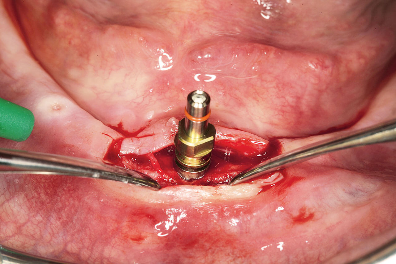 Abb. 3a Inseriertes Implantat.