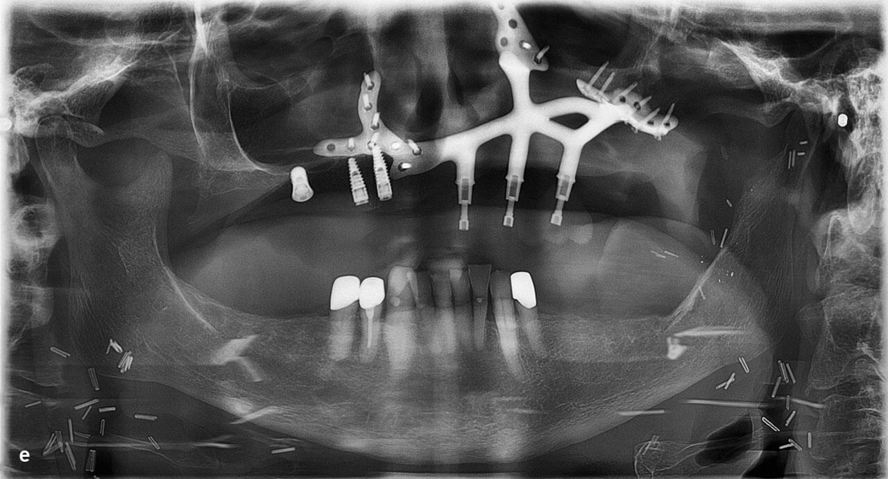 Abb. 12a bis e 87-jährige Tumorpatientin mit ausgedehntem Oberkieferkarzinom und zusätzlicher Beteiligung der unteren Mundhöhlenetage: a) Weichgewebe-Ausgangssituation nach Rekonstruktion mit Fernlappen, b) Biomodell der Hartgewebe, c) Biomodell mit Gerüstimplantat, d) Kontrolle der Implantatposition mithilfe der Bohrschablone, e) postoperatives OPT.
