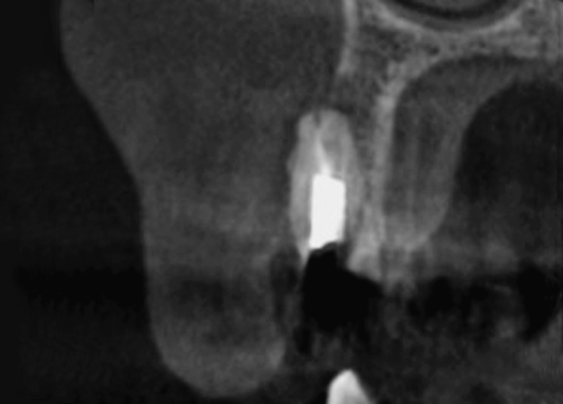 Abb. 3 Sagittalansicht des DVTs des Zahns 13 zeigt ausgeprägten Defekt der fazialen Knochenlamelle.