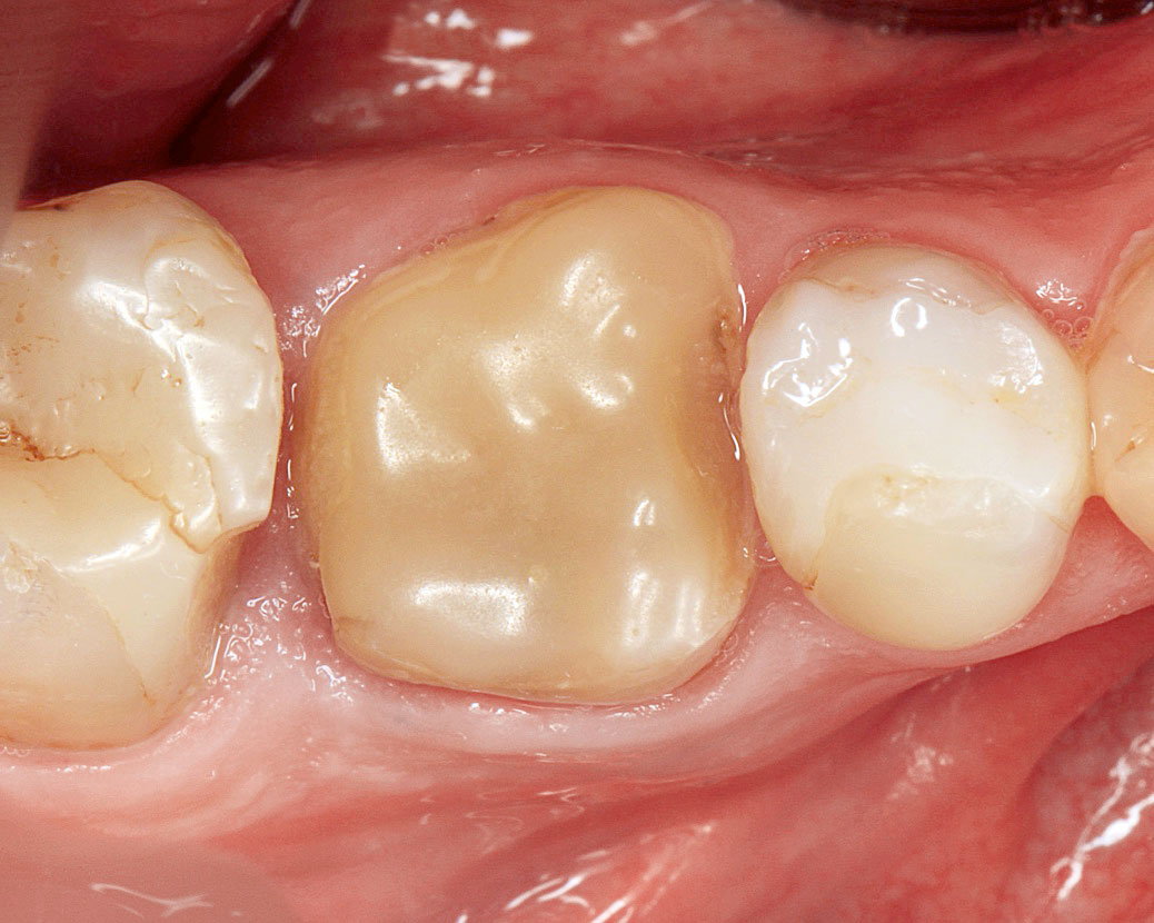Abb. 9 Sofortimplantation in Molarenextraktions­alveole mit periimplantärer Defektaugmentation in Regio 46: a) Klinische Ausgangssituation des zerstörten und nicht erhaltungswürdigen Zahns 46.