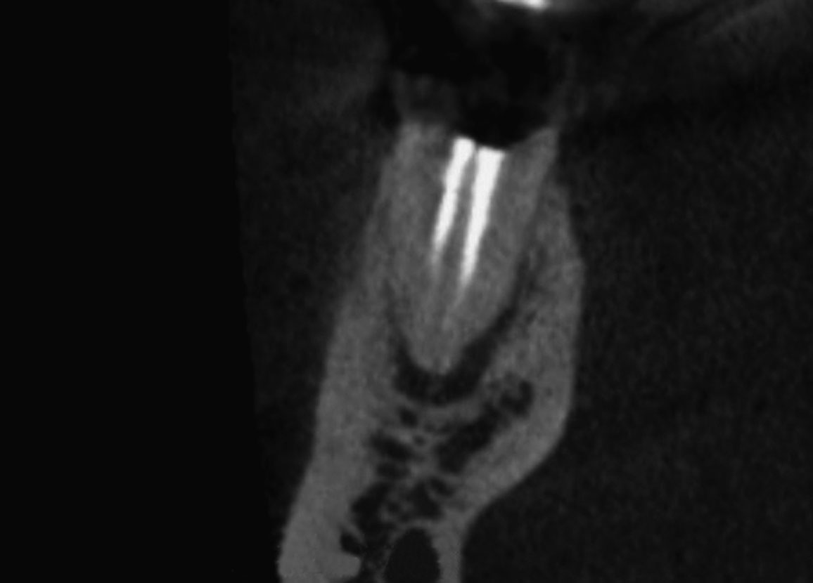 Abb. 10 Sagittalachse im DVT zeigt den insuffizient endodontisch behandelten und nicht erhaltungswürdigen Zahn 46 mit apikaler Osteolyse.