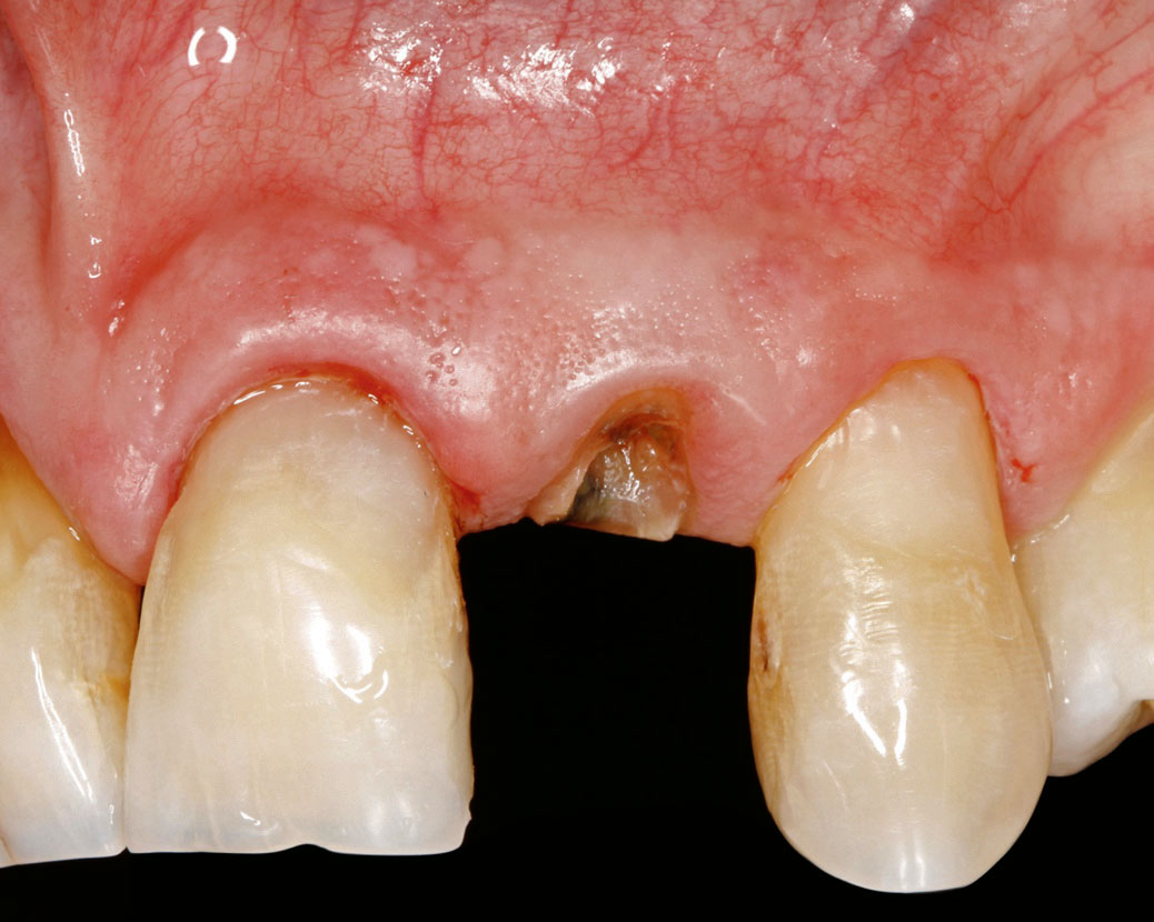 Abb. 16 Alveolarkammprävention mit BGM und nachfolgender Implantation mit provisorischer Sofortversorgung in Regio 22: a) Klinische Ausgangssituation des zerstörten Zahns 22.