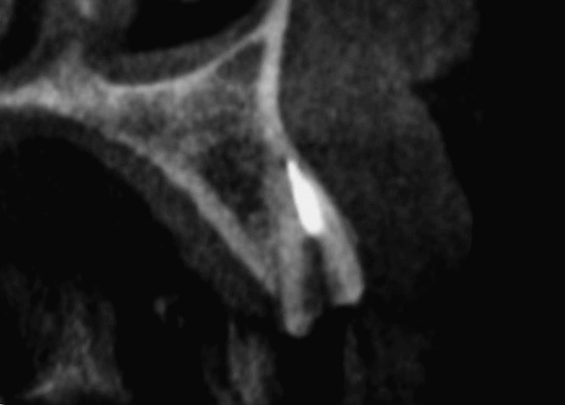 Abb. 17 Sagittalansicht der DVT des Zahns 22 zeigt die apikale Perforation der fazialen Knochenlamelle und die periapikale Osteolyse.