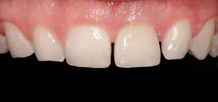 Abb. 7 Definitive Versorgung 21 direkt nach Eingliederung. Der Farbunterschied zu Zahn 11 ist durch die Austrocknung der Zähne während der Behandlung zu erklären.
