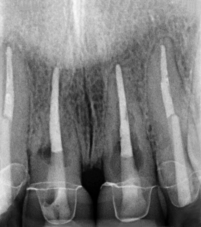 Abb. 17 Zustand zweieinhalb Jahre nach Sanierung nach Frontzahntrauma 12–22: Die Zähne 12 und 22 sind suffizient versorgt und ohne pathologischen Befund, aber 11 und 21 imponieren mit massiven Resorptionen.