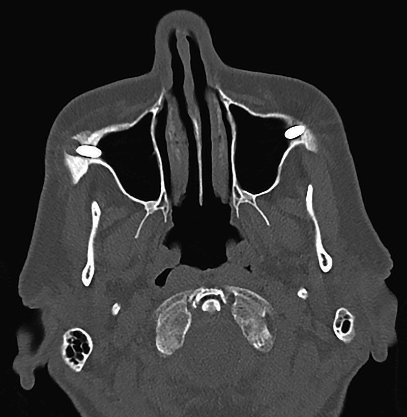 Abb. 5b ... und axiale Ansicht der 3-D-Bildgebung (CT) mit Radioopazität am Apex des rechten Zygoma­implantats.