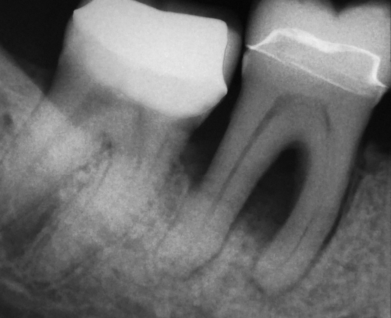 Abb. 2 Situation vor der OP: nicht erhaltenswerter Zahn 46 mit periapikaler Lyse und deutlicher Auflösung des marginalen Knochens im Sinne einer Endo-Paro-Läsion.