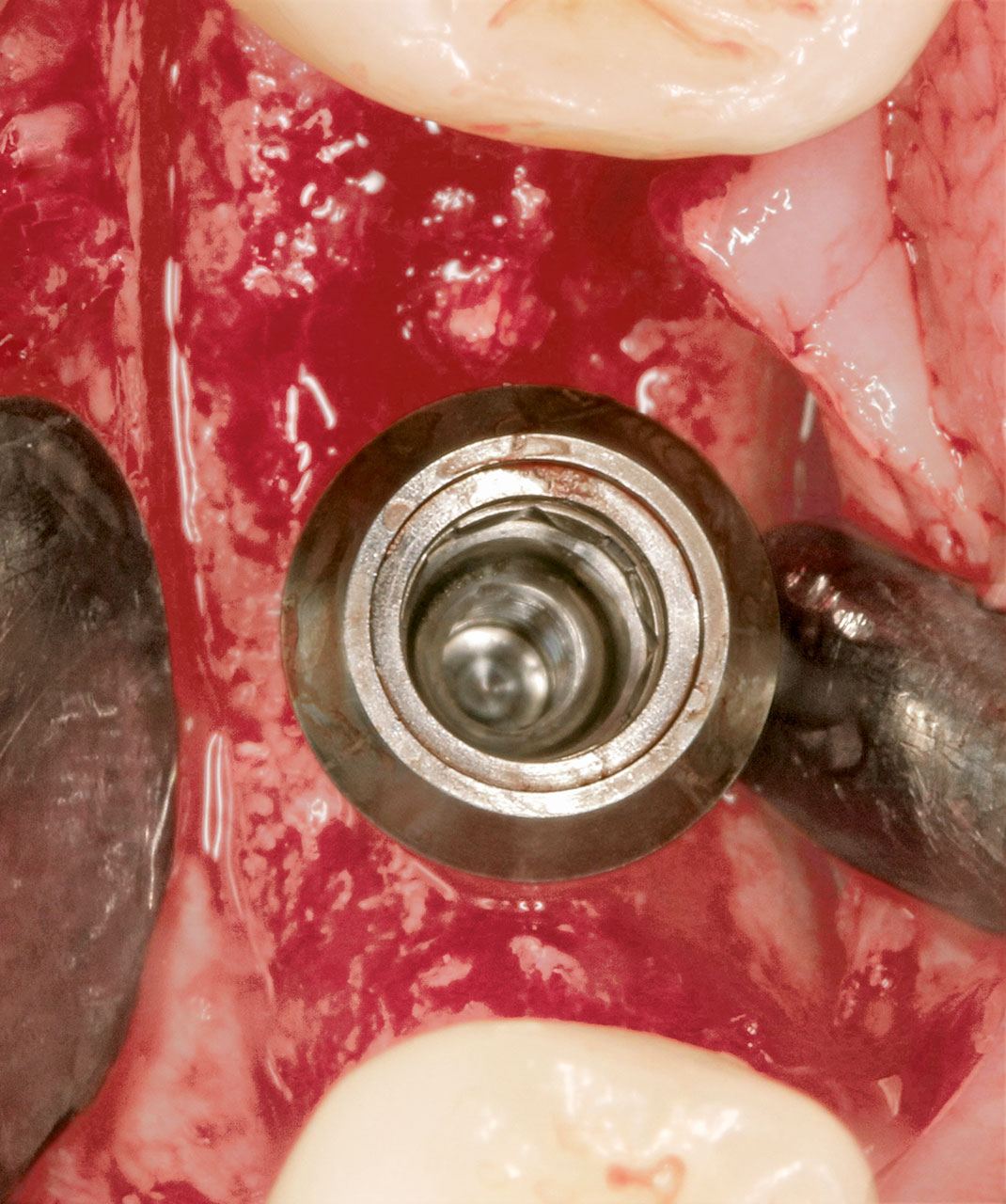 Abb. 8 Situation nach der Insertion des Implantats: ausreichendes Knochenangebot in bukkaler und apikaler Dimension für ein 10 x 4,8 mm WN-SP-TL­-SLActive-Implantat (Fa. Straumann). 