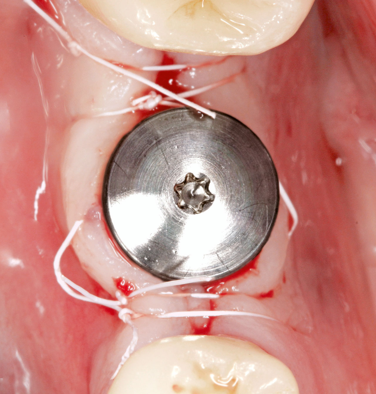 Abb. 9 Gingivaformer mit 3 mm Höhe, Nahtfixation der Lappenränder. Der keratinisierte Randabschluss bukkal und lingual des Implantats konnte vollständig erhalten werden.