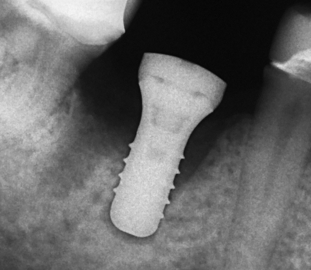 Abb. 10 Die Einzelbildkontrolle nach der Implantatinsertion zeigt korrekte Knochendimensionen um das Implantat. Der radiologisch noch nicht darstellbare Teil des neu organisierten Minerals wird histologisch erkennbar (s. Abb. 12a bis c).