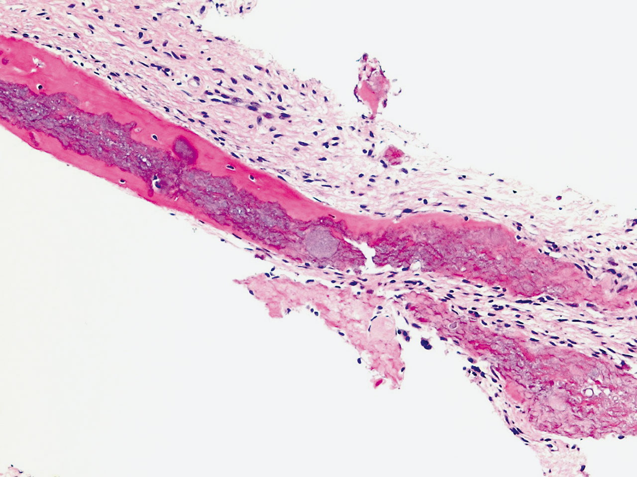 Abb. 12b Appositionelles Knochenwachstum um die basophilen Bereiche des Restkollagens beziehungsweise Granulae mit eingebetteten vitalen Knochenzellen, umsäumt von Osteoblasten; HE-Färbung, x 20.