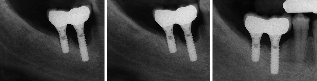 Abb. 2a Fallbeispiel einer rapide verlaufenden Periimplantitis: Zahnfilme 46–47 über einen Zeitraum von ca. 2 Jahren – die Patientin hatte zunächst der empfohlenen Therapie nicht zugestimmt, ...