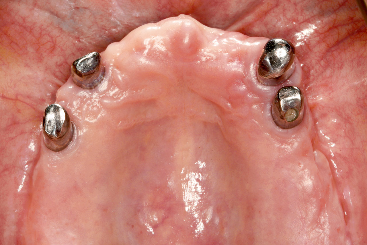 Abb. 3a Teleskopierender Zahnersatz auf einem Zahn und drei Implantaten.