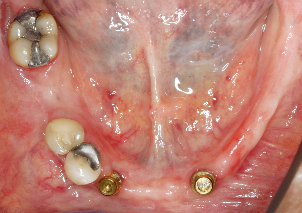 Abb. 5a Aufgrund fortgeschrittener parodontaler Schäden musste die anteriore Bezahnung (34−43) entfernt werden.