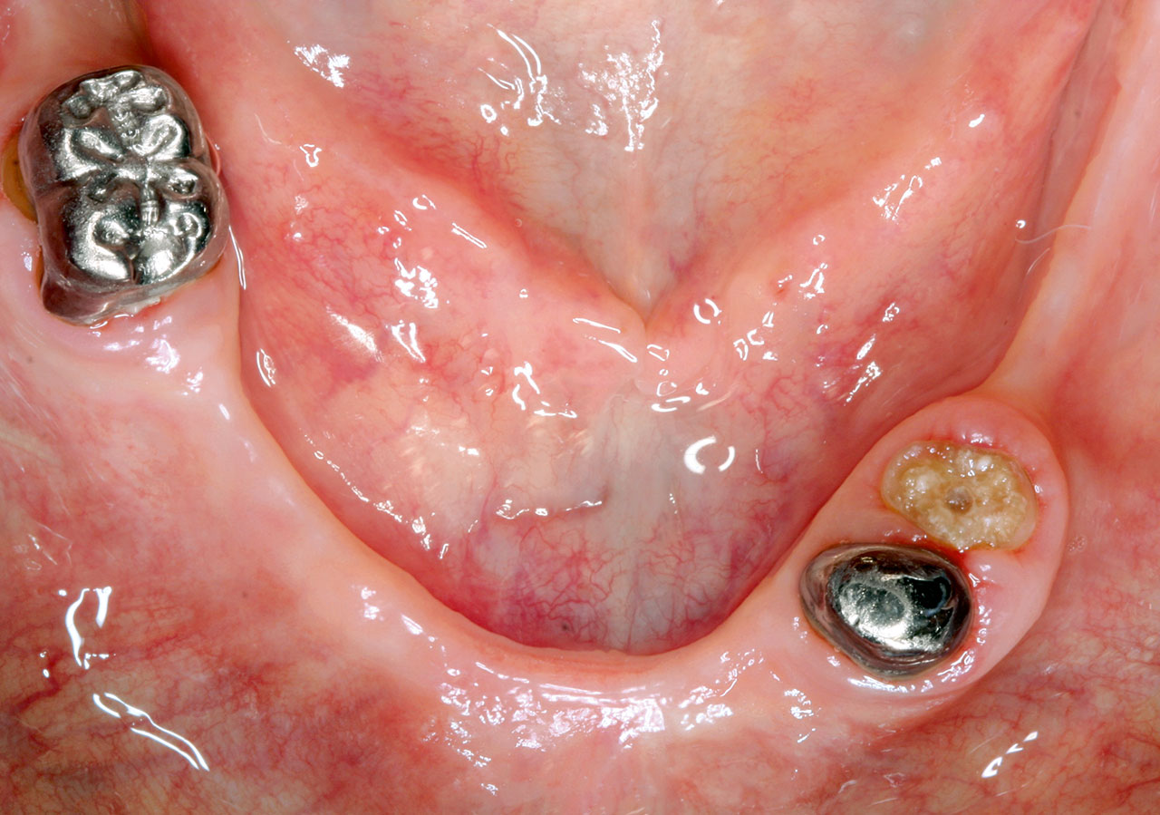 Abb. 6a Schrittweise Implantation unter vorhandenen Zahnersatz. Nach Extraktion des ehemaligen Pfeilerzahns 34 ...