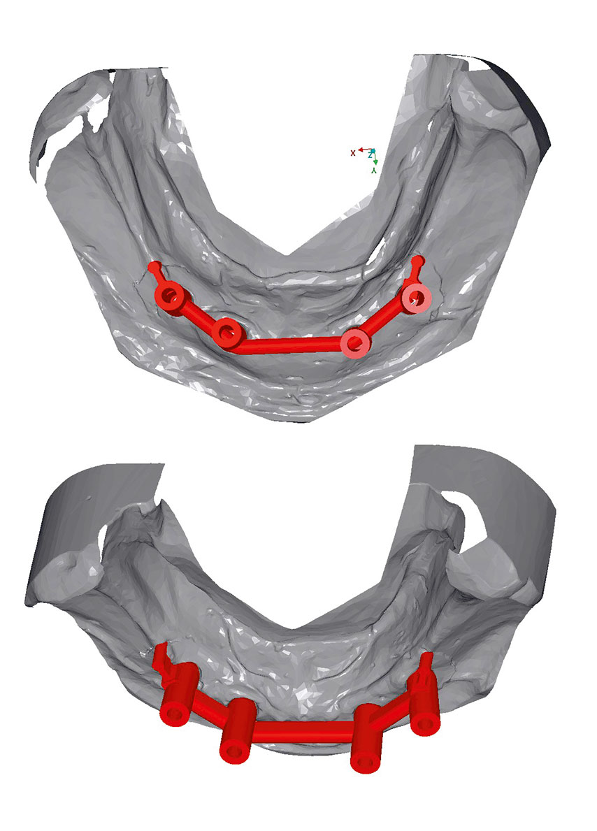 Abb. 4c ... Ansichten des virtuellen Designs für eine Unterkieferstegkonstruktion auf 4 Implantaten, ...