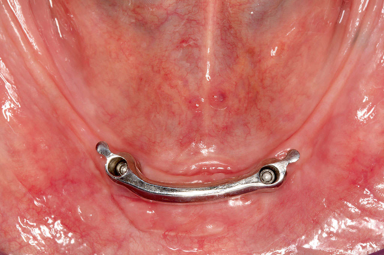 Abb. 9c ... eingegliederte Steggeschiebekonstruktion: Durch den bogenförmigen Verlauf wird eine Einengung des Zungenraums verhindert.