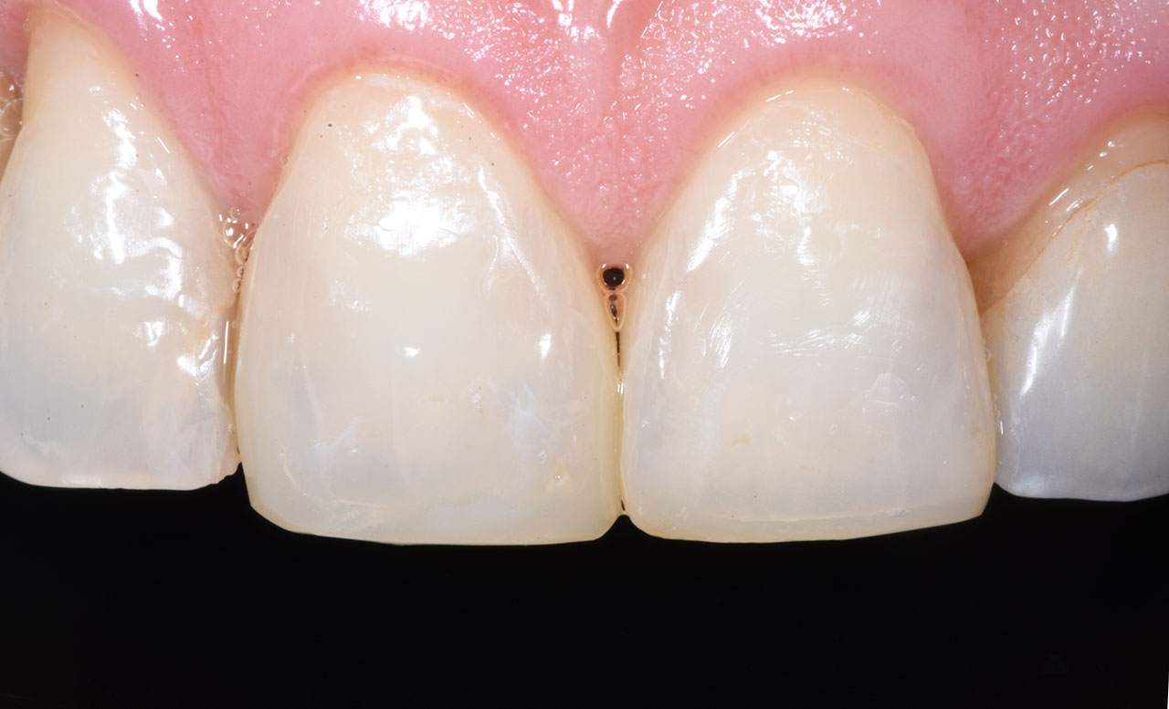 Abb. 7. Fertige Restauration nach Rehydrierung der Zahnhartsubstanz. Die Übergänge zwischen Zahnhartsubstanz und Restauration sind nur in großer Vergrößerung zu erkennen und klinisch nicht relevant.