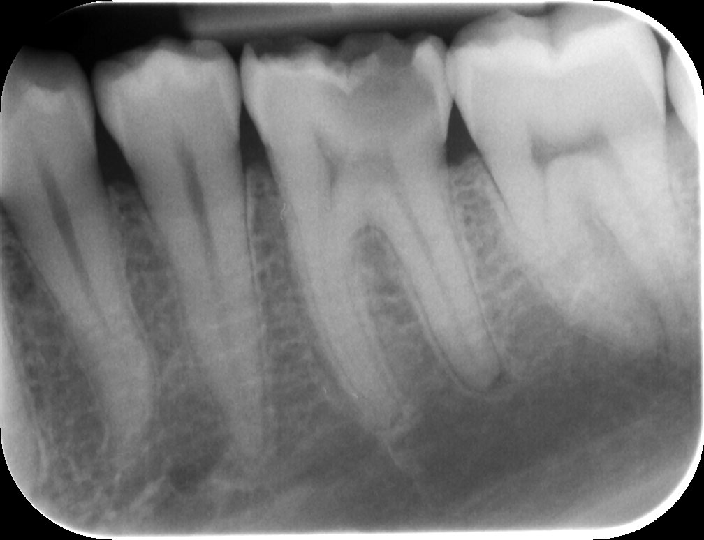 Abb. 8. Radiologischer Ausgangsbefund Zahn 36: tiefe, von okklusal ausgehende Karies, apikale Parodontitis.
