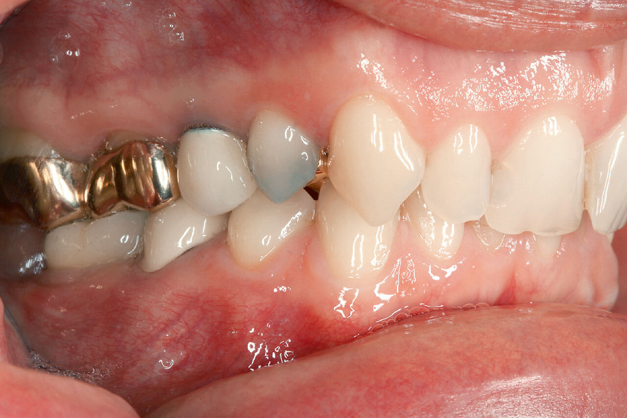 Abb. 3a bis e Klinischer Ausgangsbefund mit initialer Planung der Mittenkorrektur im Oberkiefer (Extraktion des Zahns 15 und Lückenversorgung eines Implantats in Regio 35).