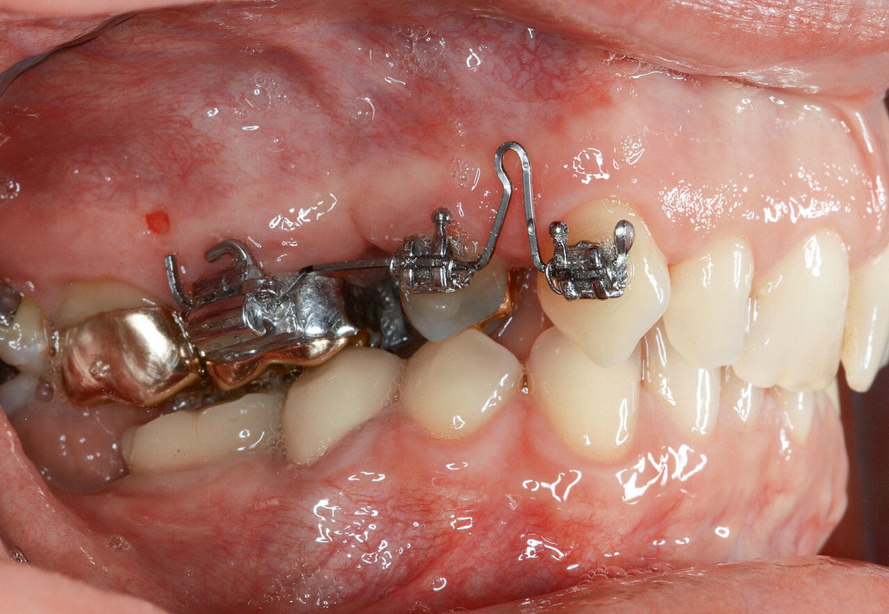 Abb. 5a und b Einleitende Behandlung: Eckzahnretraktion, initiale Mittenkorrektur. Einsatz einer Segmentapparatur; Extraktion des Zahns 15, Distalisierung der Zähne 14 und 13 mit Teilbögen (017x025 TMA).