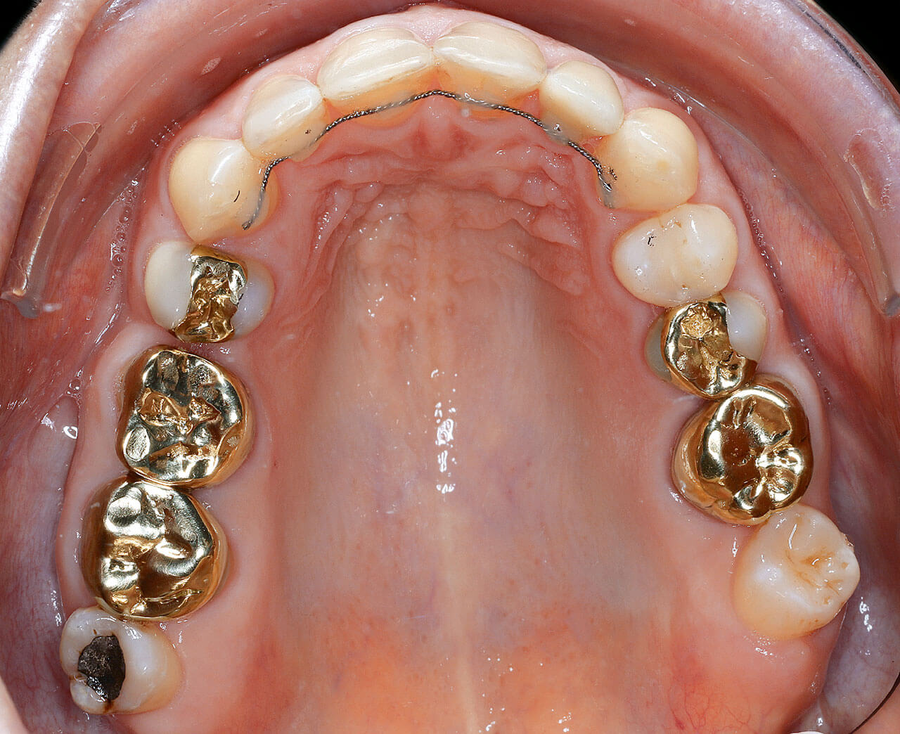 Abb. 9a bis e Prothetisch/konservierende Versorgung mit odontoplastischem Kompositaufbau an Zahn 12 und Kronenversorgung an Zahn 22 sowie Implantatversorgung an Zahn 35 und Krone an Zahn 46.